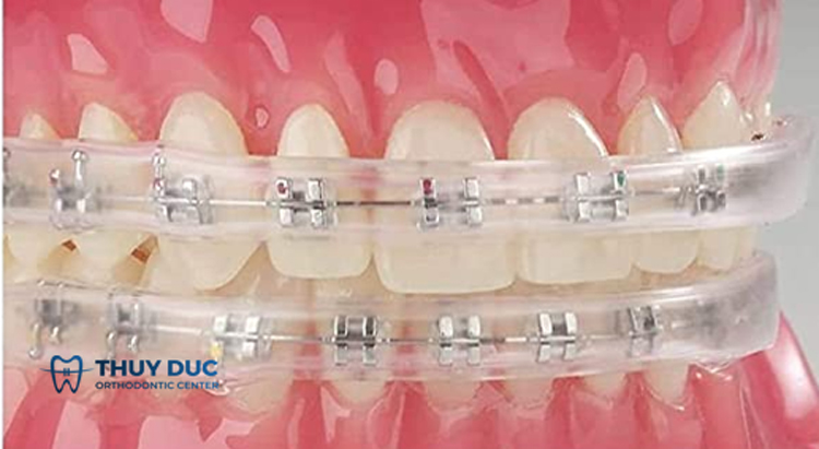 7. Sử dụng các lớp phủ silicone chỉnh nha 1