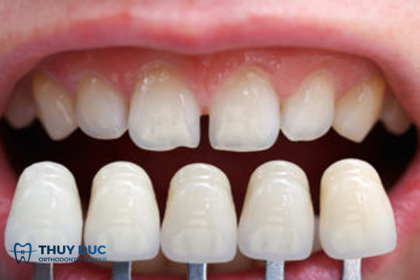 Bọc răng sứ cải thiện nhanh chóng tình trạng răng thưa 2