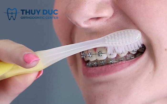 Chải răng quá mạnh 1 Chải răng quá mạnh 1