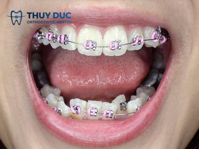 Niềng răng mắc cài 1