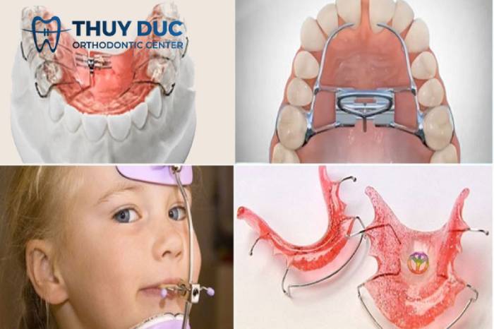 Điều trị móm răng ở trẻ nhỏ 1