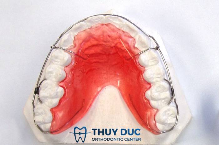 Tìm hiểu từ A-Z về các loại khí cụ chỉnh nha 1