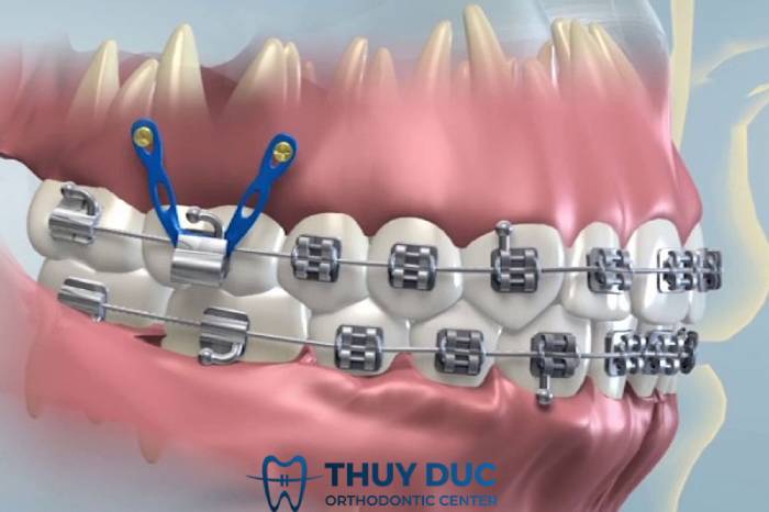 Minivis (Vít niềng răng) 1