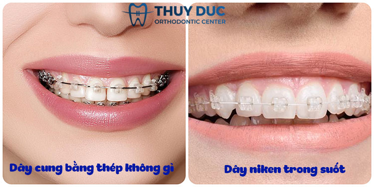 Mắc cài sứ tự buộc là gì? 2