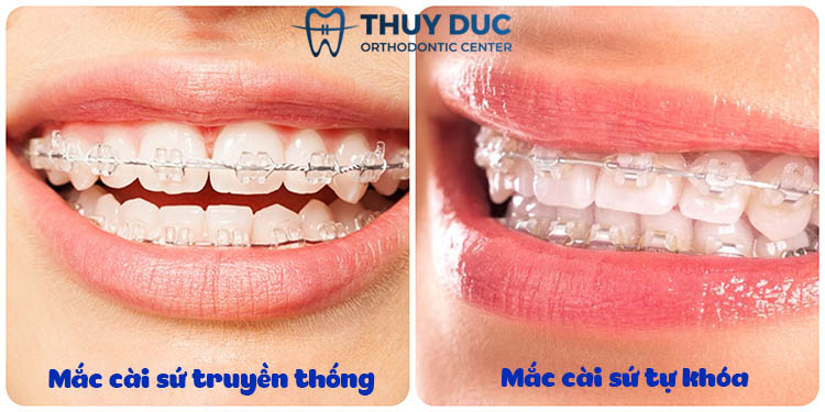 Niềng răng mắc cài sứ được làm từ chất liệu gì? 1