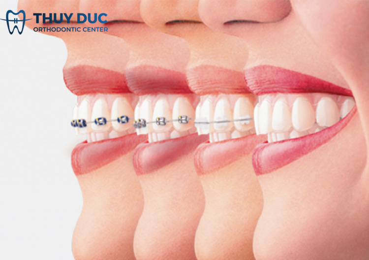 Sau khi niềng răng 1 Sau khi niềng răng 1