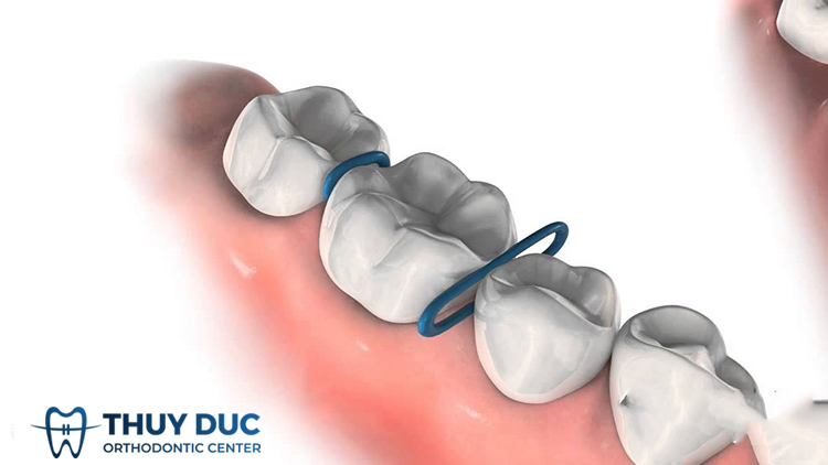 Thun tách kẽ cao su 1 Thun tách kẽ cao su 1