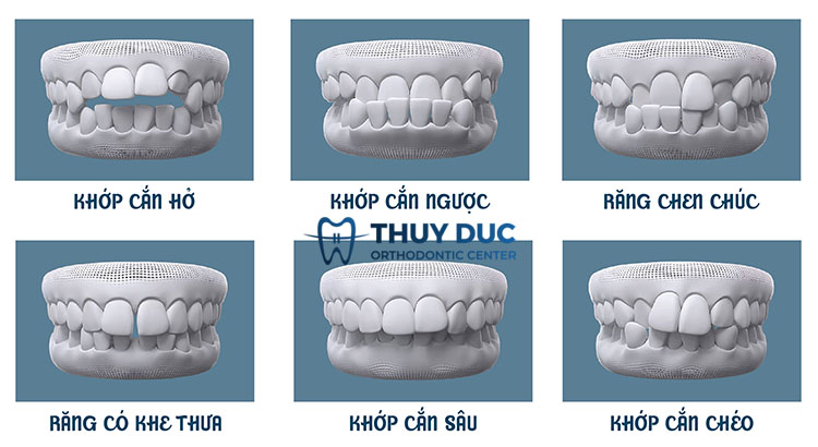Làm sao để biết được con bạn có cần niềng răng hay không? 1