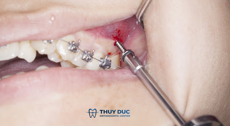 Do kích ứng với khí cụ niềng răng 1 Do kích ứng với khí cụ niềng răng 1