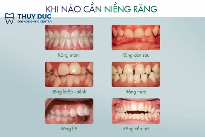 Chỉnh nha tháo lắp là gì? 1 Chỉnh nha tháo lắp là gì? 1