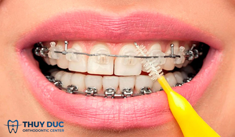 Chăm sóc răng miệng đúng cách 1 Chăm sóc răng miệng đúng cách 1