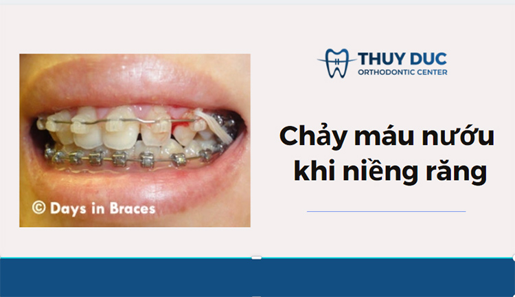Chảy máu khi niềng răng - Nguyên nhân và cách xử lý? 1 Chảy máu khi niềng răng - Nguyên nhân và cách xử lý? 1