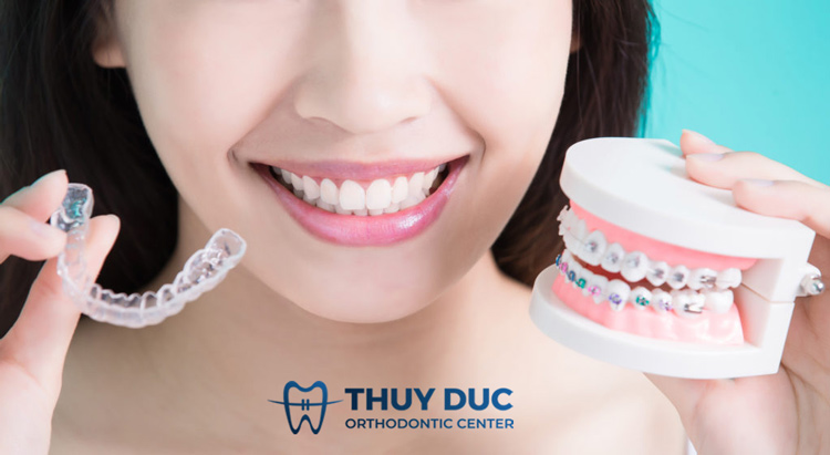 Chạy răng sau khi niềng răng là gì? 1 Chạy răng sau khi niềng răng là gì? 1