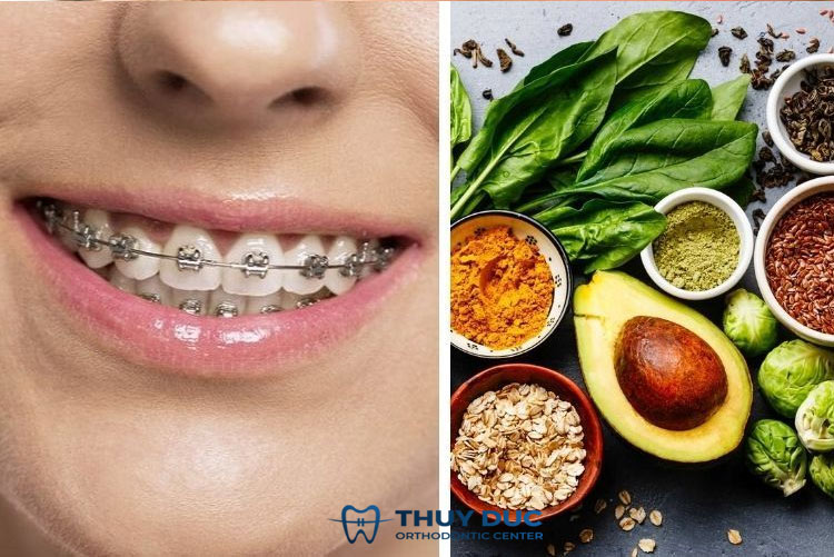 Các phương pháp tại nhà giúp bạn giảm đau khi niềng răng 1 Các phương pháp tại nhà giúp bạn giảm đau khi niềng răng 1