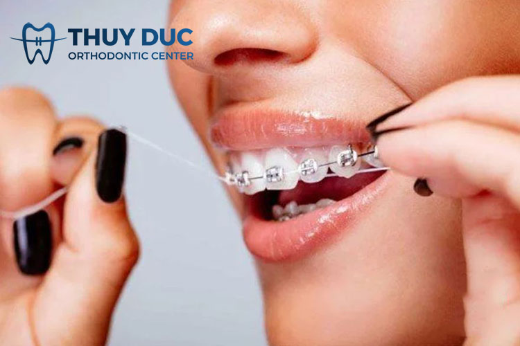 Vệ sinh răng miệng đúng cách khi niềng răng 2 Vệ sinh răng miệng đúng cách khi niềng răng 2