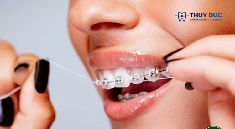 1. Vệ sinh răng miệng sau mỗi bữa ăn và ăn nhẹ để tránh hơi thở có mùi với niềng răng 3