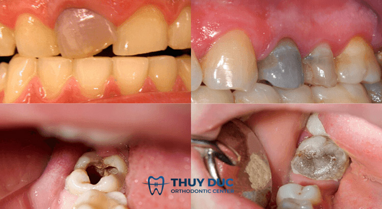 Tại sao răng bị chết tủy? 1 Tại sao răng bị chết tủy? 1