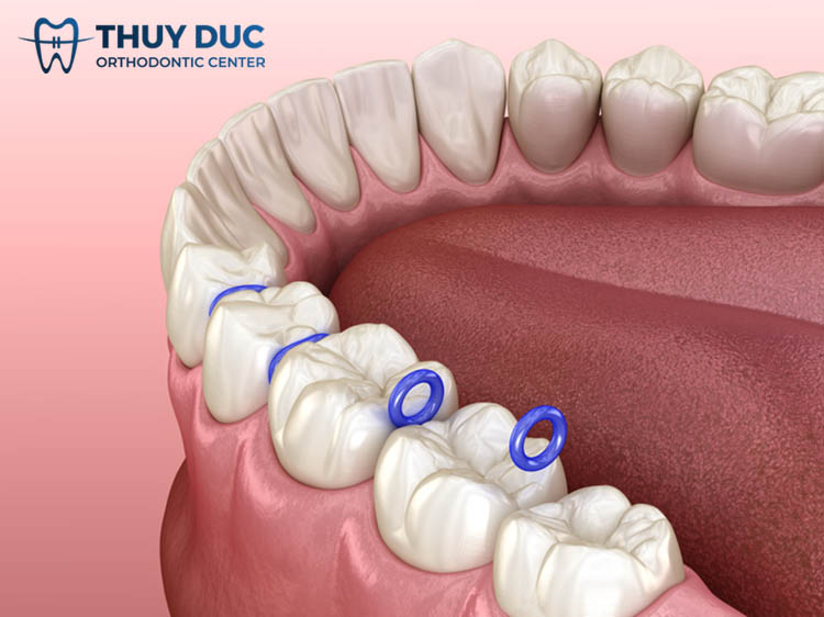 Đặt thun tách kẽ có đau không, phải đặt trong bao lâu? 1 Đặt thun tách kẽ có đau không, phải đặt trong bao lâu? 1