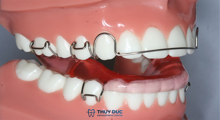 Hàm duy trì tháo lắp 1