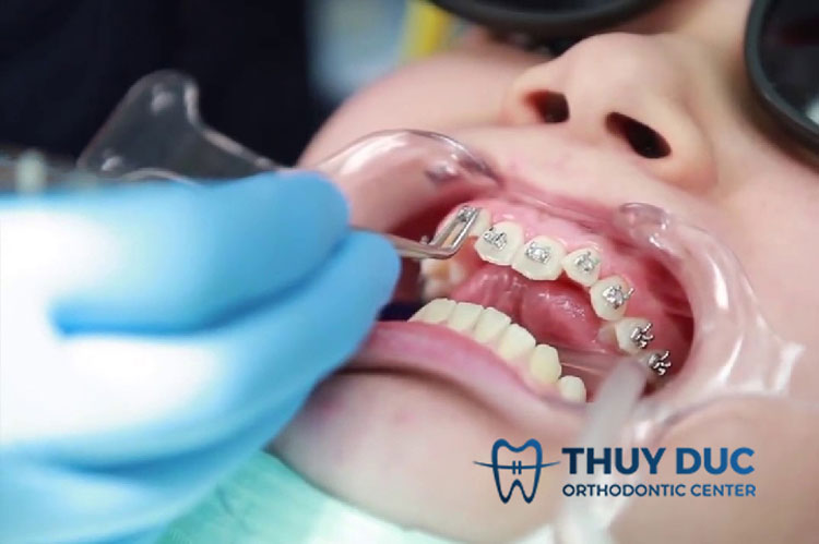 Quy trình niềng răng mắc cài 2 Quy trình niềng răng mắc cài 2