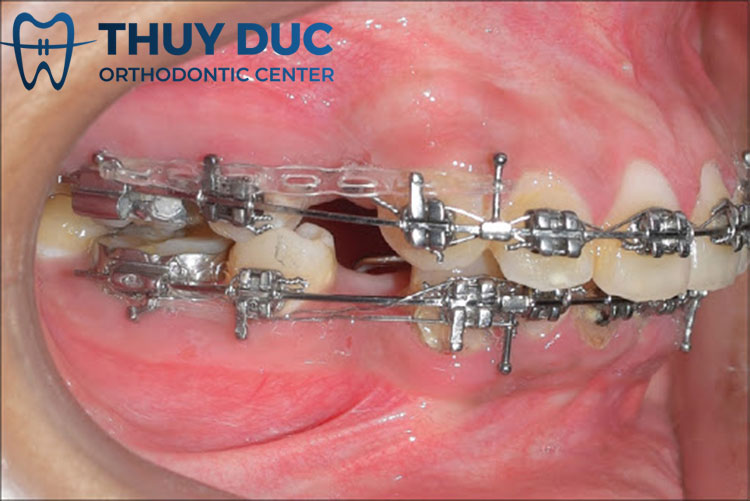 Giai đoạn đóng khoảng trong niềng răng 1 Giai đoạn đóng khoảng trong niềng răng 1