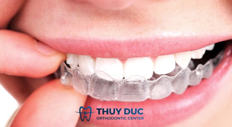 4. Cách xử lý và phòng ngừa chạy răng sau khi niềng răng 1 4. Cách xử lý và phòng ngừa chạy răng sau khi niềng răng 1