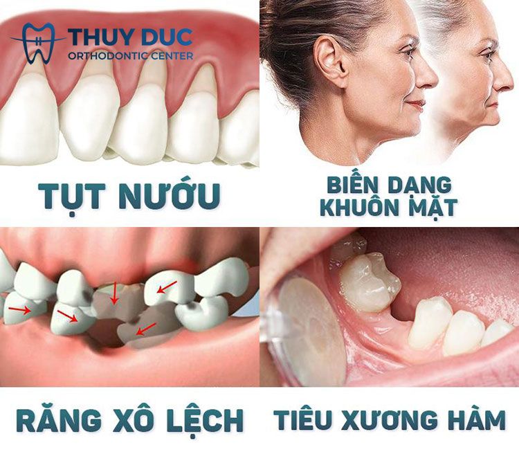 Tiêu xương hàm 1 Tiêu xương hàm 1