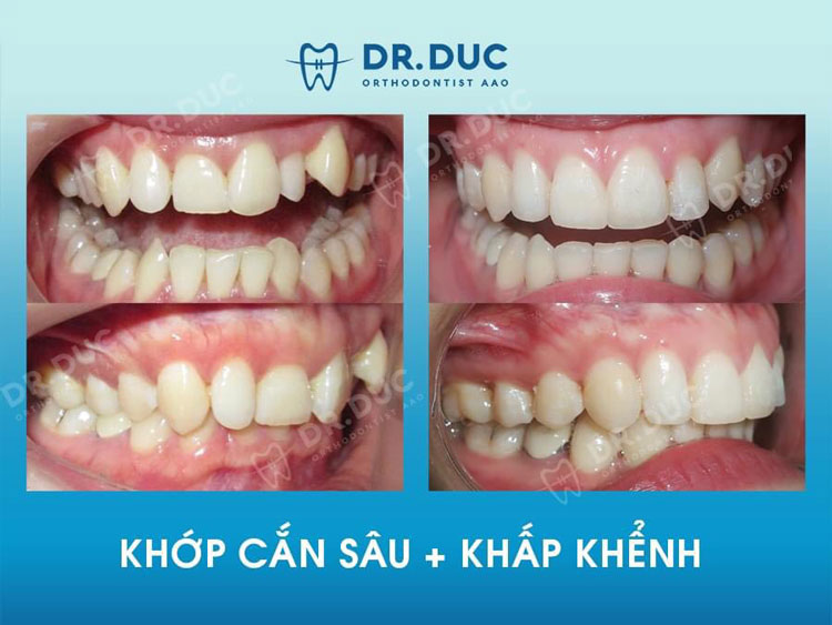 Khớp cắn sâu là gì? 1