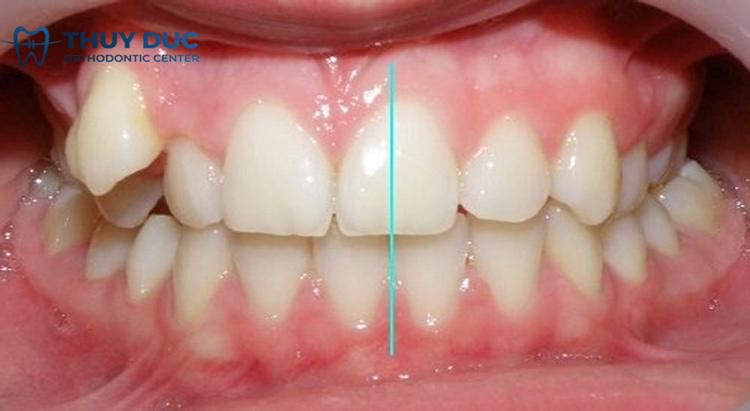 Tại sao cần nhổ bỏ răng khi niềng răng? 2 Tại sao cần nhổ bỏ răng khi niềng răng? 2