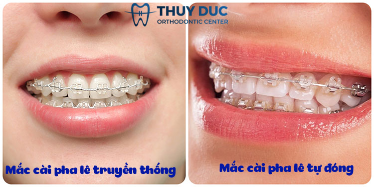 Mắc cài pha lê và mắc cài sứ có phải cùng là 1 loại? 1 Mắc cài pha lê và mắc cài sứ có phải cùng là 1 loại? 1