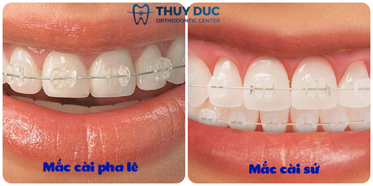 Nên chọn mắc cài pha lê hay mắc cài sứ? 1 Nên chọn mắc cài pha lê hay mắc cài sứ? 1