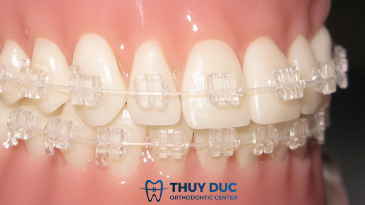 Chi phí mắc cài sứ 1