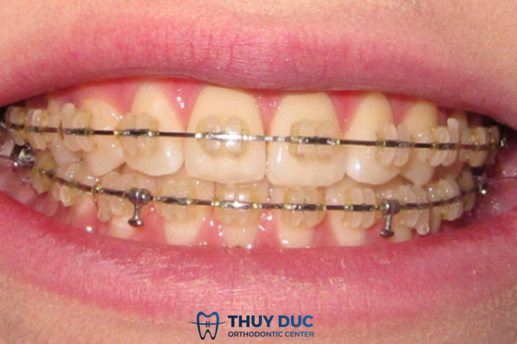 Tiết lộ 3 lí do khiến mắc cài sứ bị ố vàng sau 1 thời gian 1 Tiết lộ 3 lí do khiến mắc cài sứ bị ố vàng sau 1 thời gian 1