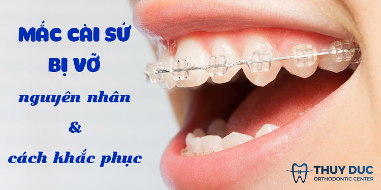 Mắc cài sứ bị vỡ - nguyên nhân và cách khắc phục tốt nhất 1