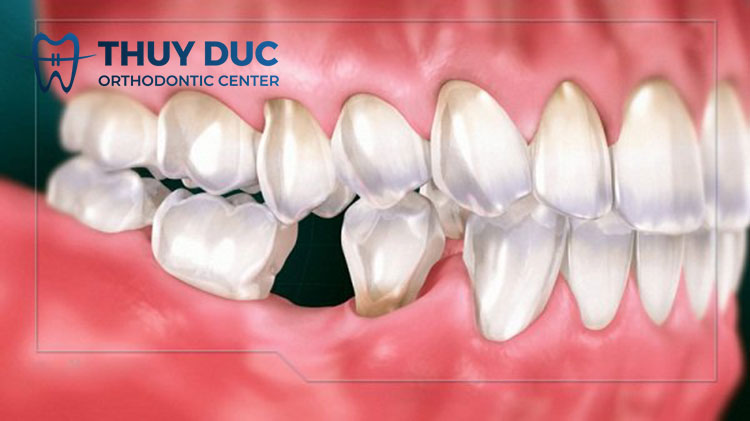Bị mất răng số 6 có niềng răng được không? 1 Bị mất răng số 6 có niềng răng được không? 1