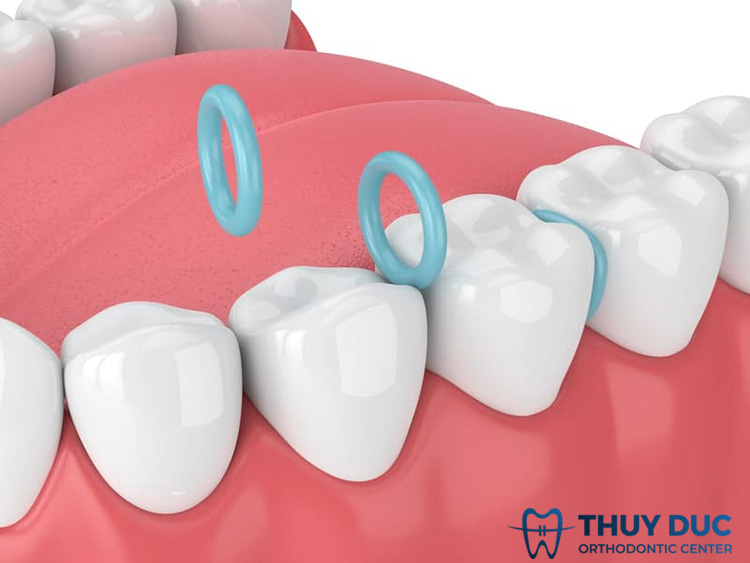 Thun tách kẽ là gì? Có tác dụng gì? 1 Thun tách kẽ là gì? Có tác dụng gì? 1