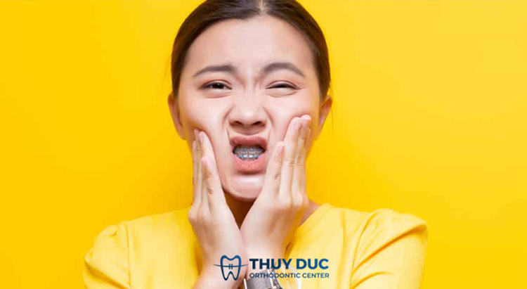 Có những loại thuốc giảm đau nào được sử dụng phổ biến khi niềng răng?
