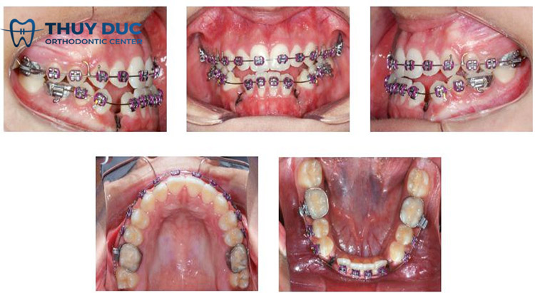 Tại sao cần nhổ bỏ răng khi niềng răng? 1 Tại sao cần nhổ bỏ răng khi niềng răng? 1