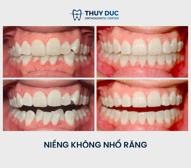 Niềng răng không nhổ răng là gì? 1 Niềng răng không nhổ răng là gì? 1