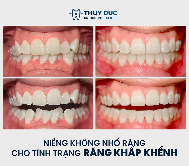 Bạn có thể niềng răng mà không nhổ răng 2