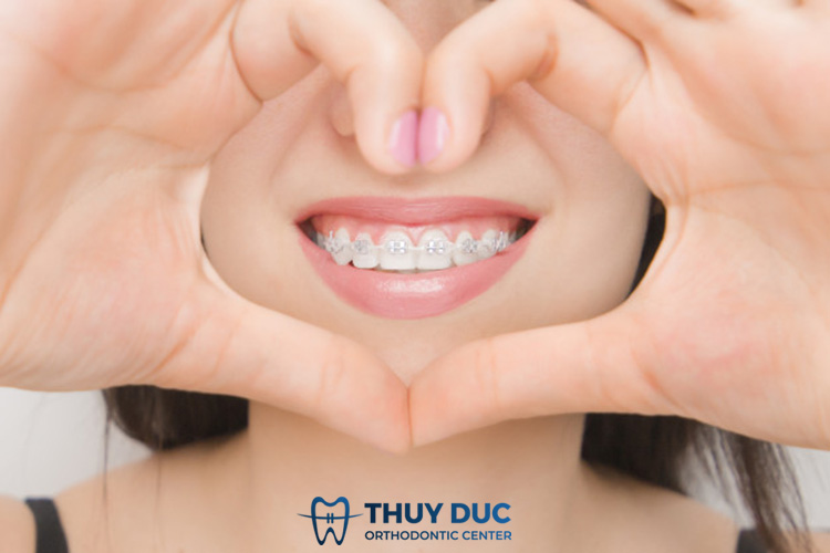 Niềng răng trẻ em bằng mắc cài cố định 1 Niềng răng trẻ em bằng mắc cài cố định 1