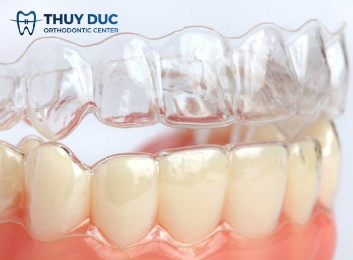 Chi phí nắn chỉnh răng khấp khểnh bằng phương pháp Invisalign 1