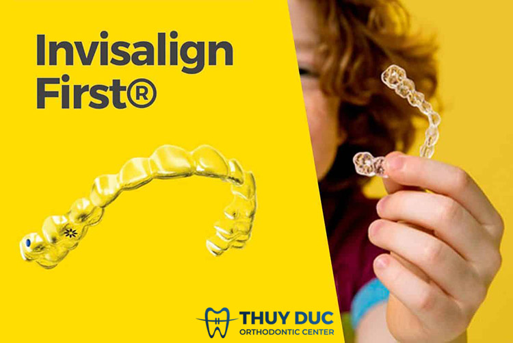 Mách bạn phương pháp niềng răng mới nhất cho trẻ 1