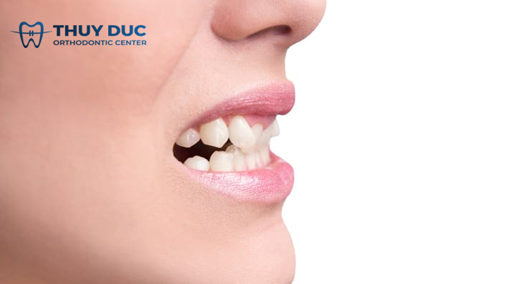 Niềng răng khấp khểnh có đắt không? Tổng chi phí hết bao nhiêu? 1