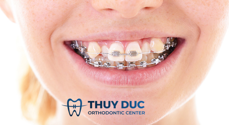 Nguyên nhân nào gây ra tình trạng răng chen chúc, khấp khểnh? 1