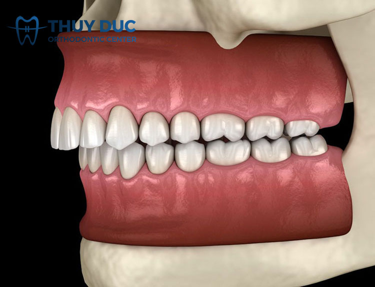 Tại sao nên niềng răng khớp cắn sâu? Có hiệu quả hay không? 1