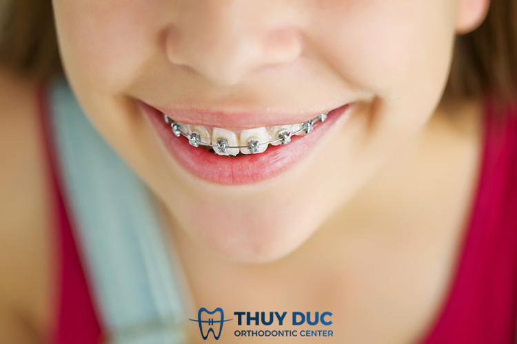 Chi phí niềng răng mắc cài kim loại 2