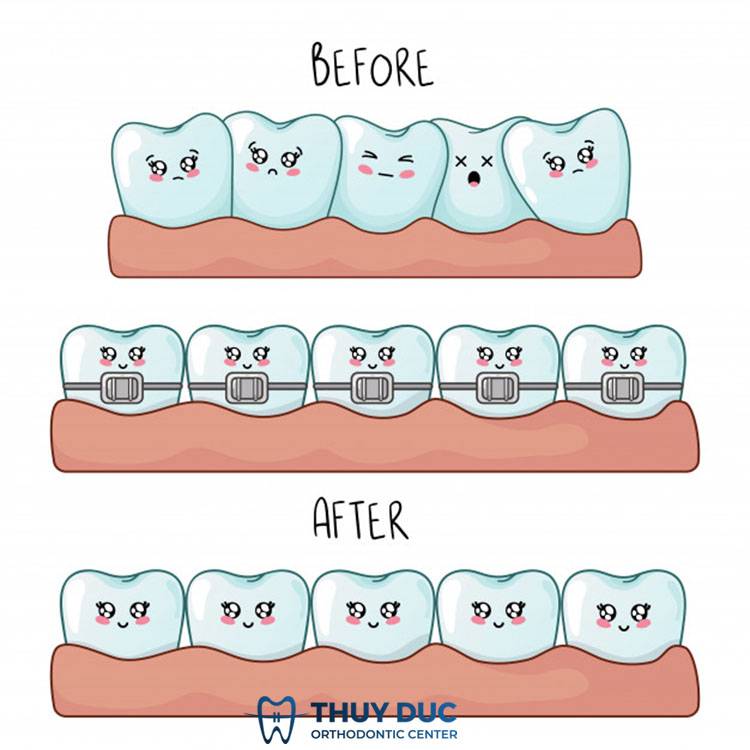 Niềng răng mắc cài kim loại mang lại nhiều lợi ích hơn là răng đều 1 Niềng răng mắc cài kim loại mang lại nhiều lợi ích hơn là răng đều 1