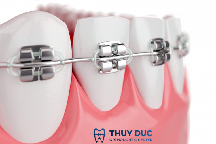 Niềng răng mắc cài kim loại 1