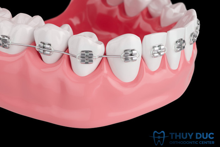 Niềng răng mắc cài kim loại truyền thống 1 Niềng răng mắc cài kim loại truyền thống 1